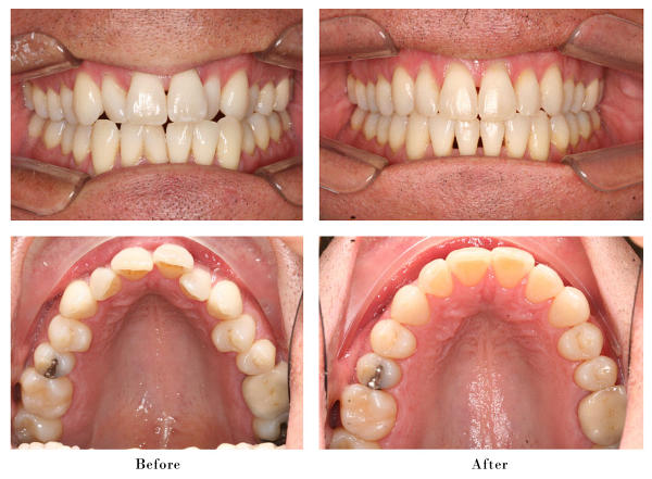 zoom teeth whitening los angeles